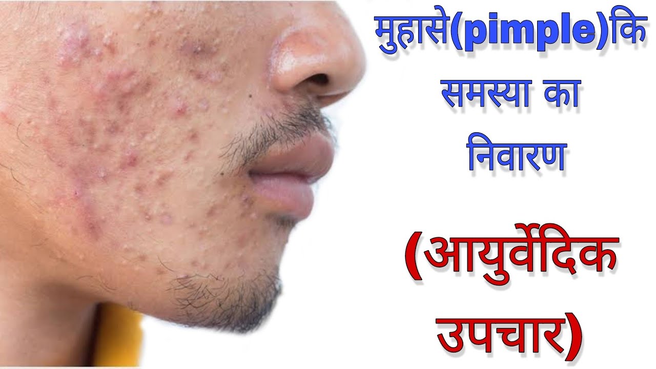 || मुहासे (pimple) की समस्या का निवारण ||     (आयुर्वेदिक उपचार )